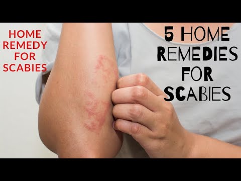 Video: 5 Home Remedies For Scabies