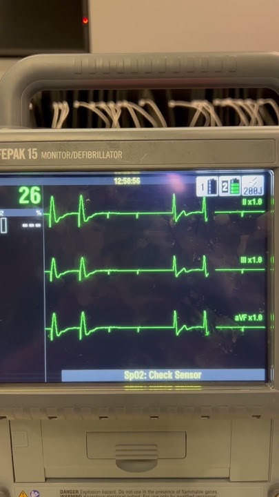 Pacemaker with Loss of capture - YouTube