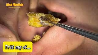 耳掃除 -Cục ráy cứng đầu ghê ..cảm giác nằm trong tai thế nào ta?- earwax-asmr- Minh MenHair