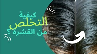 تخلص من القشرة مع هذه العلاجات المنزلية الطبيعية ||| عالم الطبيعة