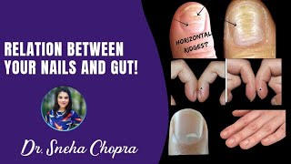 Famous Your Nails Help Diagnose Nutrient Deficiencies- Dr. Sneha Chopra Profile