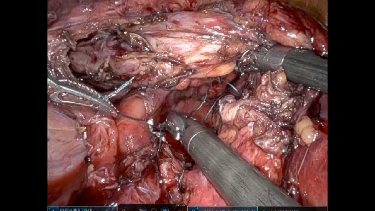 Truncal vagotomy and heineke mikulicz pyloroplasty