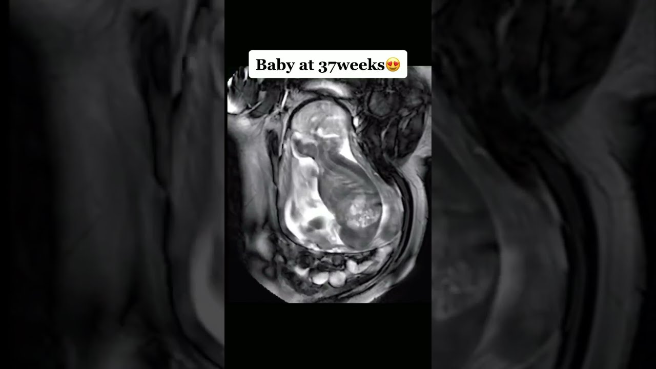 Baby At 37 Weeks Moving In Womb YouTube Baby At 37 Weeks Moving In Womb YouTube