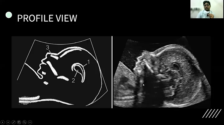 Anomaly Scan target Scan II Trimester Scan - Dr. Prabhu .C. S