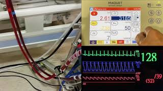 ECMO Telesimulation
