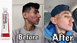 My 2 Year experience with Tretinoin | Face Acne Treatment