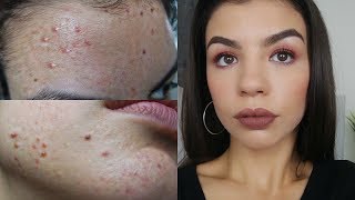 ACNE COVERAGE MAKEUP TUTORIAL AND FOUNDATION ROUTINE 2018
