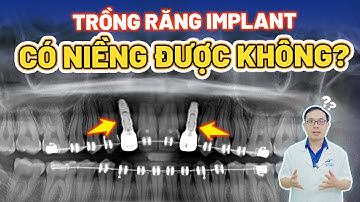 Trồng Implant Có Niềng Được Không: Tiết Kiệm Bội Tiền Nhờ Niềng Răng Trước Khi Trồng Implant
