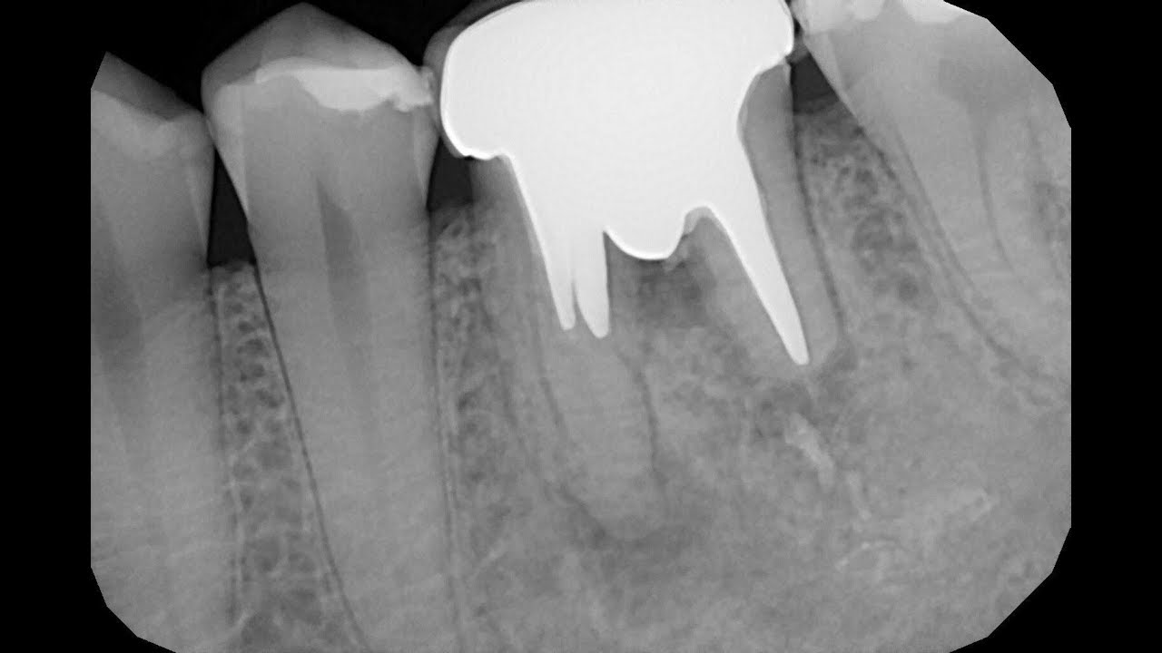 2 корня в зубе. Ленточная перфорация зуба. Перфорация корня зуба культевой вкладкой. Перфорация корня зуба на рентгене. Стекловолоконный штифт на кт.
