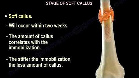 How Does Broken Bone Heal ?