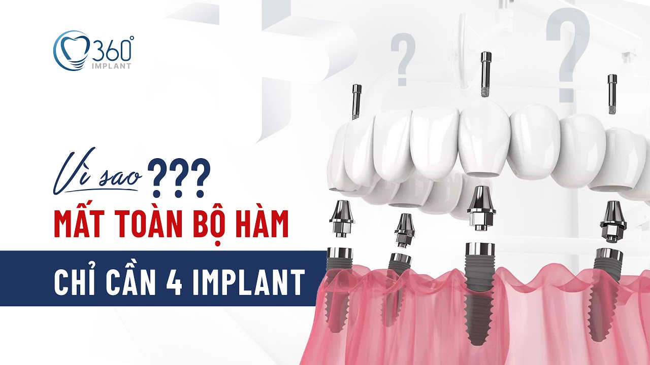 Outline Video Vì Sao Mất Toàn Bộ Hàm Răng Chỉ Cần Trồng 4 Trụ Implant ThS BS Phạm Hùng Sơn