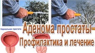 Струйный диагноз – аденома простаты. Чем лечить простатит.(, 2015-04-23T20:17:09.000Z)