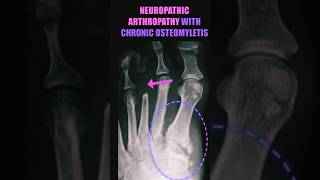 Neuropathic Arthropathy with Chronic Osteomyelitis #shorts #diabetes #radiology