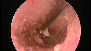 Earwax Removal As Peeling Acne