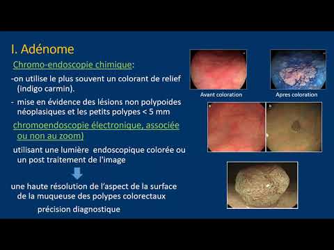 Vidéo: Polype Adénomateux: Symptômes, Traitement, Photos, Formes, Diagnostic