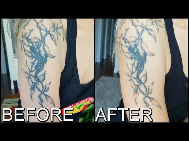 Laser Tattoo Removal Perth - Ocean Cosmetics Skin & Laser