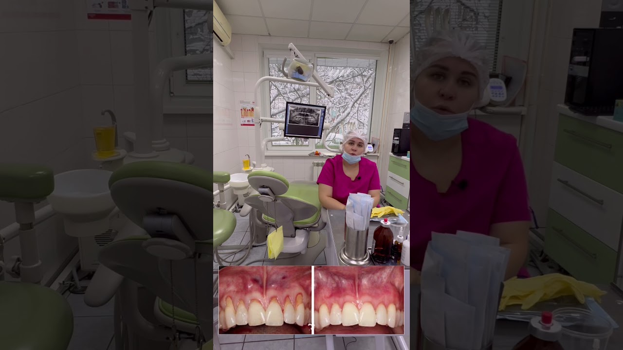 Плазмолифтинг дёсен