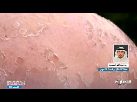 الأشعة فوق البنفسجية خطيرة ينصح بعدم التعرض لأشعة الشمس من الساعة 10 صباحا إلى 4 عصرا في فصل الصيف