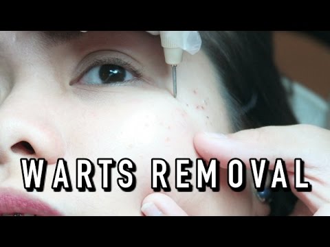 warts treatment let s face it review