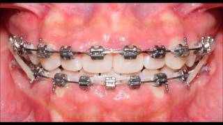 Retratamiento de Ortodoncia en 6 Meses (Brackets) | OrtoDental México