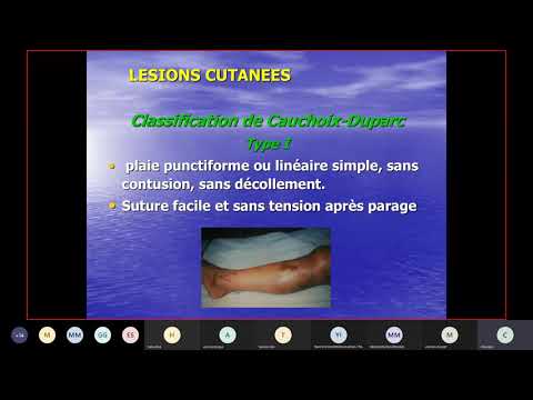 Vidéo: Fracture De La Jambe - Symptômes, Gonflement Et Traitement Des Fractures De La Jambe Ouvertes Et Fermées. Comment Développer Une Jambe?