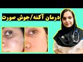 درمان جوش صورت یا آکنه اگه جوش داری بهترین ویدیویه که کمکت میکنه درمان جوش صورت یا آکنه اگه جوش داری بهترین ویدیویه که کمکت میکنه