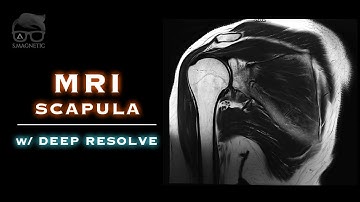 MRI – SCAPULA w/DEEP RESOLVE