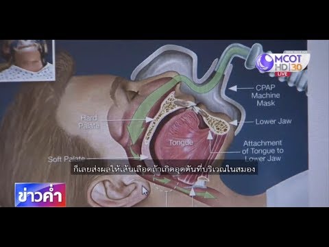 ชัวร์ก่อนแชร์ : นอนกรนเสี่ยงโรคอันตราย จริงหรือ?