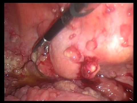Tumore Ovarico Avanzato