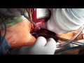 Double Superior Vena Cava Cannulation for Venous Drainage in Minimally Invasive Aortic Valve Surgery