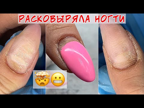 Расковыряла ногти / Снова борозды на ногтях