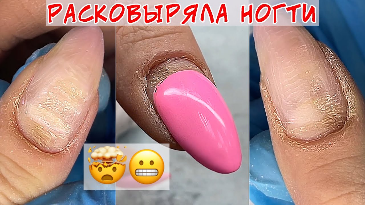 Расковыряла ногти / Снова борозды на ногтях