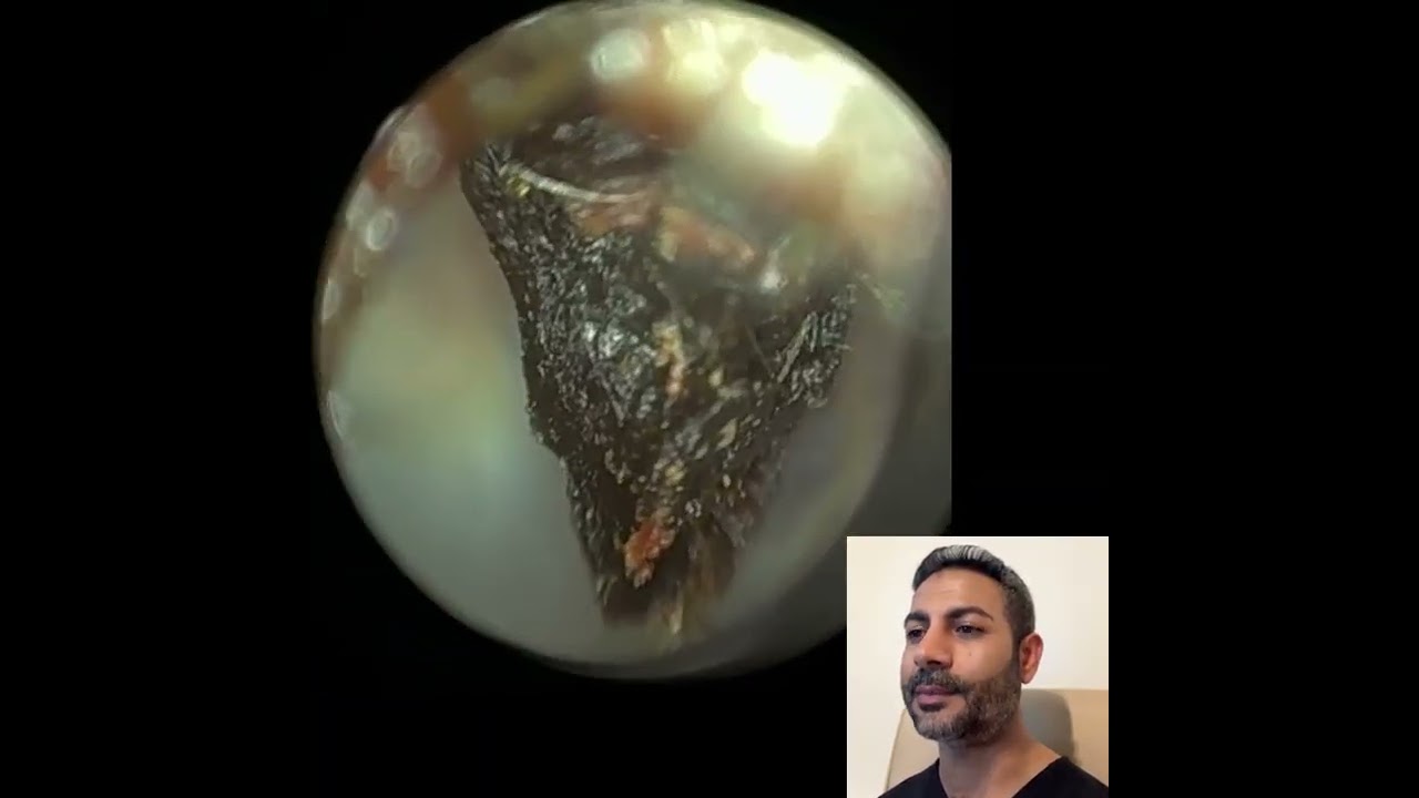 439 - Удаление древней ушной серы с помощью WAXscope®