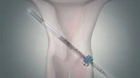 Mirena Insertion Animation