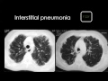 Imaging of Diffuse lung diseases   Prof Dr  Mamdouh Mahfouz In Arabic