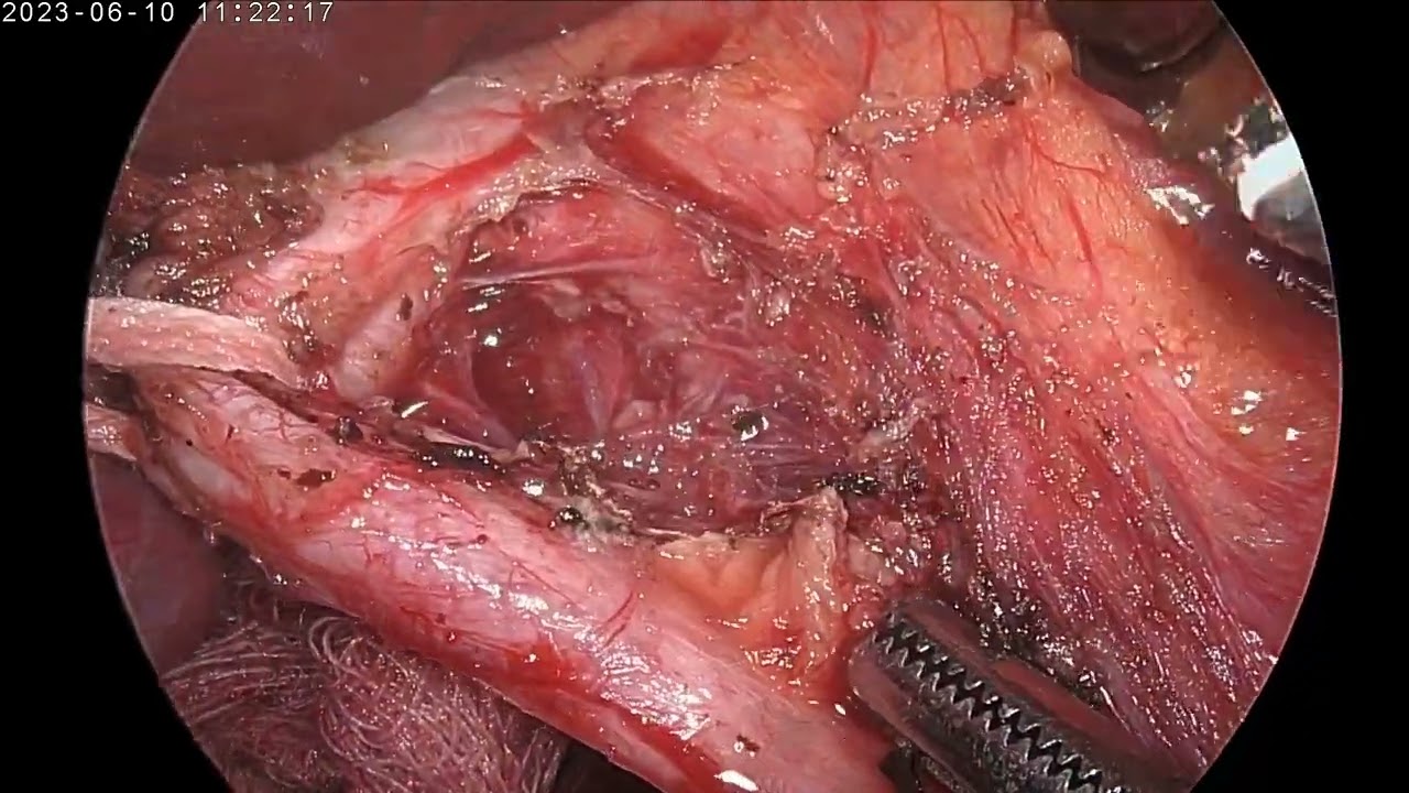 laparoscopic  choledochal cyst excision with hepaticojejunostomy by Dr Rashesh Solanki
