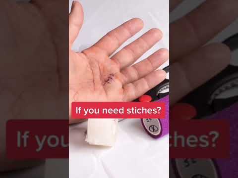 Video: Ārsta apstiprināti padomi, kā uzzināt, vai jūsu dūriens ir salauzts