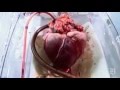 Beating heart transplant hospital amazing