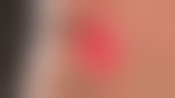 Laparoscopic Retrograde Appendicectomy | Appendix Surgery | Appendicectomy | Dr. Imran Abdullah Khan