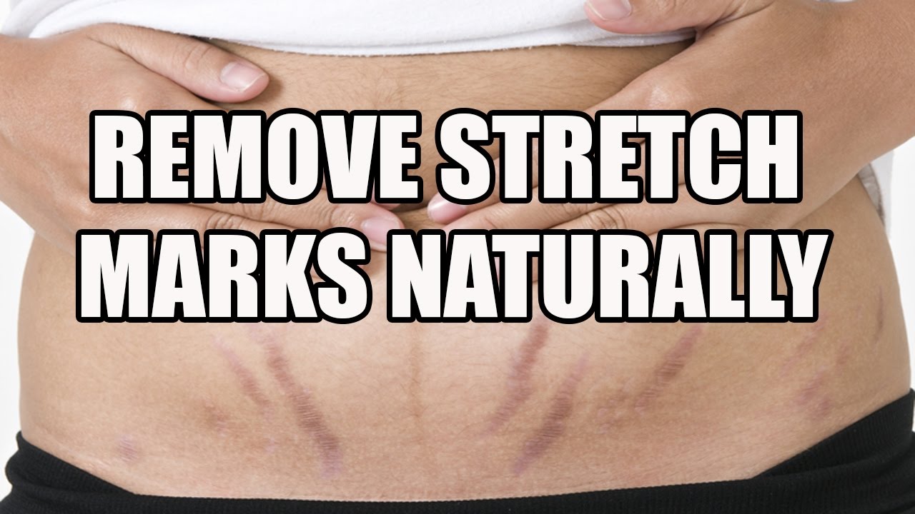 How To Get Rid Of Stretch Marks Fast Home Remedies For Stretch Marks