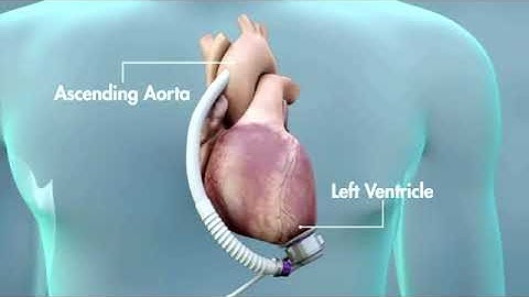 LVAD animation