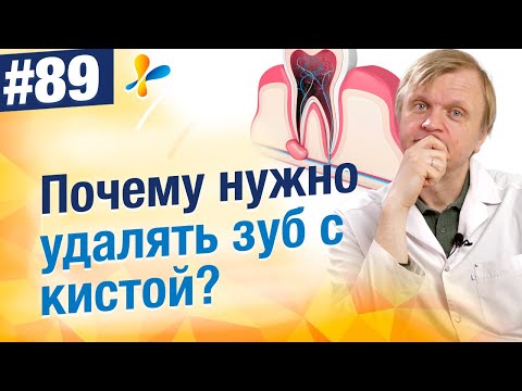 Киста зуба. Нужно удалять зуб или можно еще полечить? История пациента с кистой на верхней челюсти.