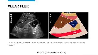 Gastric Ultrasound to Verify Full or Empty Stomach -- This is Easy to Learn