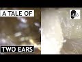 An EPIC Tale of Two Ears: Bilateral Ear Wax Removal - #371