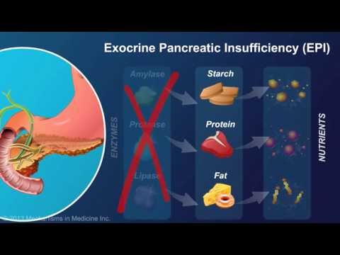 Exokrinní pankreatická insuficience