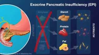 Exocrine Pancreatic Insufficiency