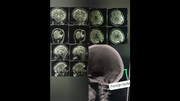 Kleine metaalachtige artefacten op MRI | Metaalachtige artefacten in MRI #artefacten #mri