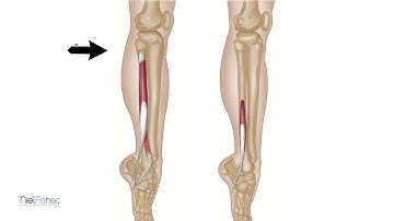 Twisted Ankles and Trigger Points - Peroneus (Fibularis) Muscles