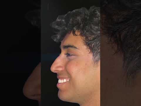 Video thumbnail: WOW! Ethnic Rhinoplasty Before and After Results #nosejobs · Dr. Anthony Corrado