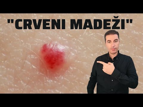 Video: Da li je angioma trešnje kancerogena?